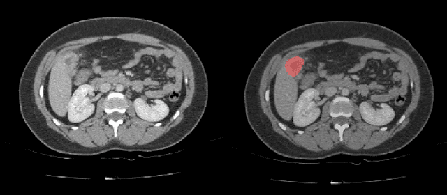 Figure 1 for Automatic segmentation of kidney and liver tumors in CT images