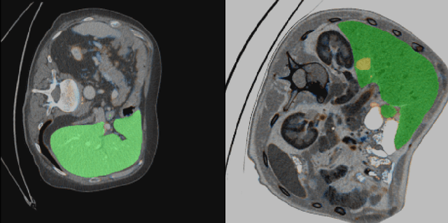 Figure 3 for Automatic segmentation of kidney and liver tumors in CT images