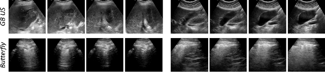 Figure 3 for Unsupervised Contrastive Learning of Image Representations from Ultrasound Videos with Hard Negative Mining