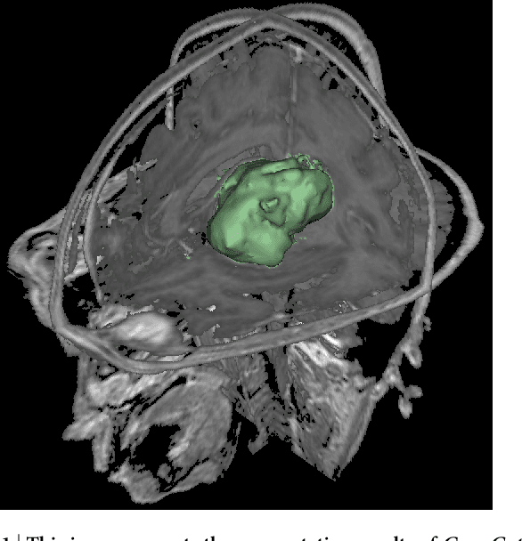 Figure 2 for GBM Volumetry using the 3D Slicer Medical Image Computing Platform