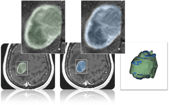 Figure 4 for GBM Volumetry using the 3D Slicer Medical Image Computing Platform