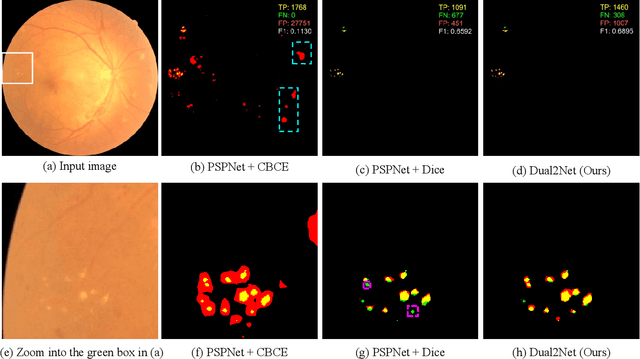 Figure 2 for Dual-Branch Network with Dual-Sampling Modulated Dice Loss for Hard Exudate Segmentation from Colour Fundus Images