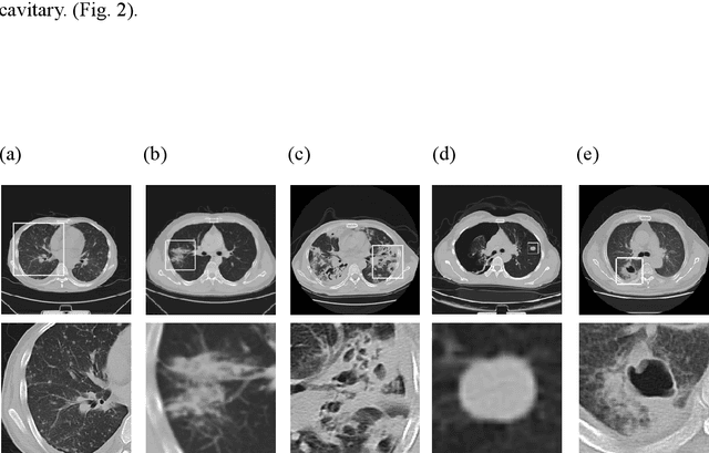 Figure 3 for A Deep Learning System That Generates Quantitative CT Reports for Diagnosing Pulmonary Tuberculosis