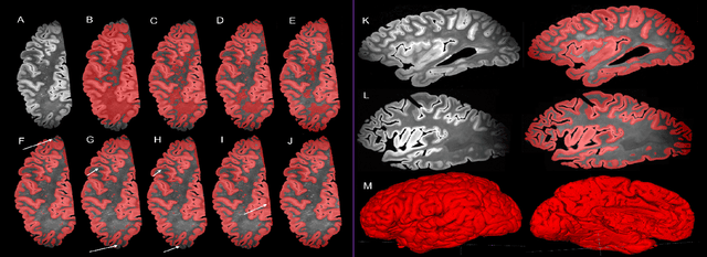 Figure 3 for Gray Matter Segmentation in Ultra High Resolution 7 Tesla ex vivo T2w MRI of Human Brain Hemispheres