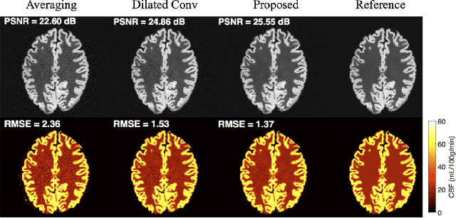 Figure 3 for DeepASL: Kinetic Model Incorporated Loss for Denoising Arterial Spin Labeled MRI via Deep Residual Learning