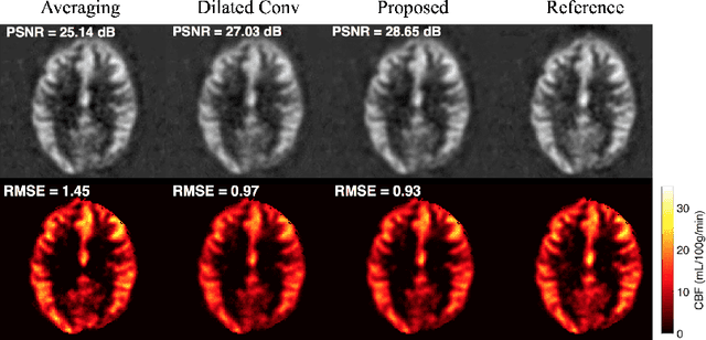 Figure 4 for DeepASL: Kinetic Model Incorporated Loss for Denoising Arterial Spin Labeled MRI via Deep Residual Learning
