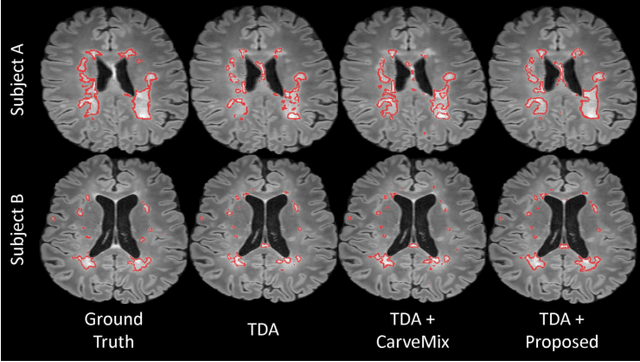 Figure 4 for Subject-Specific Lesion Generation and Pseudo-Healthy Synthesis for Multiple Sclerosis Brain Images