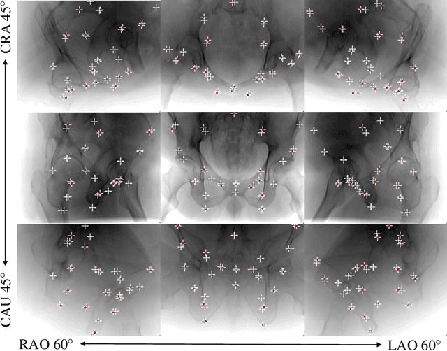 Figure 3 for X-ray-transform Invariant Anatomical Landmark Detection for Pelvic Trauma Surgery