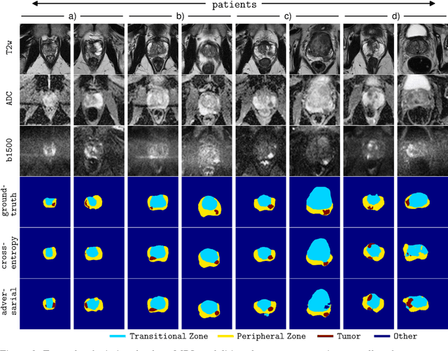 Figure 3 for Adversarial Networks for Prostate Cancer Detection