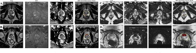 Figure 2 for Federated Learning with Research Prototypes for Multi-Center MRI-based Detection of Prostate Cancer with Diverse Histopathology