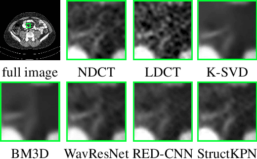 Figure 3 for Low-Dose CT Denoising Using a Structure-Preserving Kernel Prediction Network