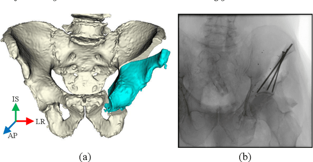 Figure 1 for Fast and Automatic Periacetabular Osteotomy Fragment Pose Estimation Using Intraoperatively Implanted Fiducials and Single-View Fluoroscopy