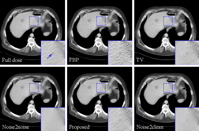 Figure 1 for Consensus Neural Network for Medical Imaging Denoising with Only Noisy Training Samples