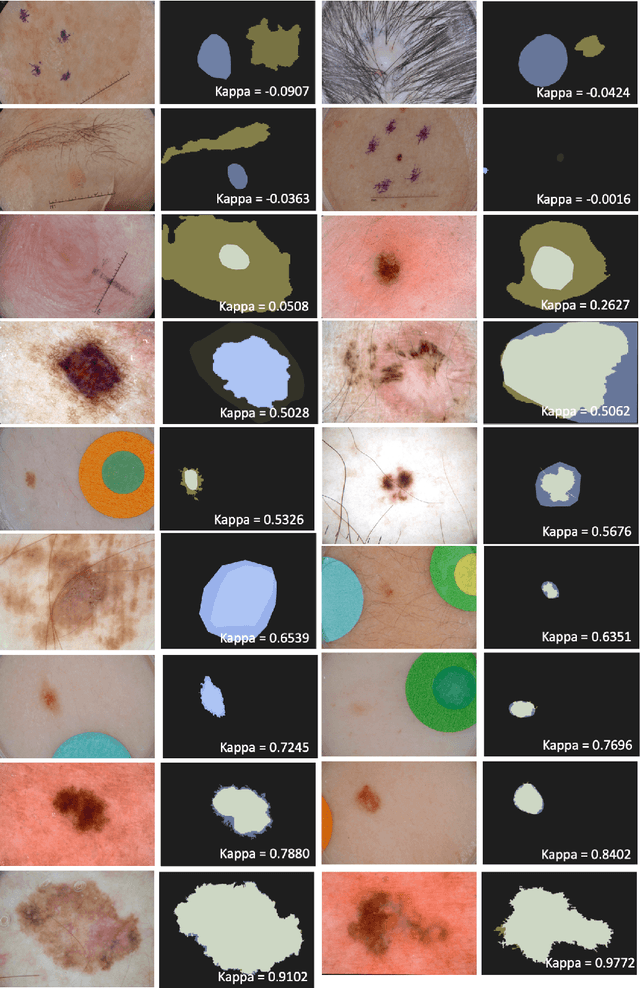 Figure 2 for Handling Inter-Annotator Agreement for Automated Skin Lesion Segmentation
