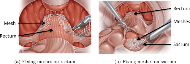 Figure 3 for Offline identification of surgical deviations in laparoscopic rectopexy