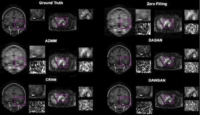 Figure 3 for Deep Attentive Wasserstein Generative Adversarial Networks for MRI Reconstruction with Recurrent Context-Awareness