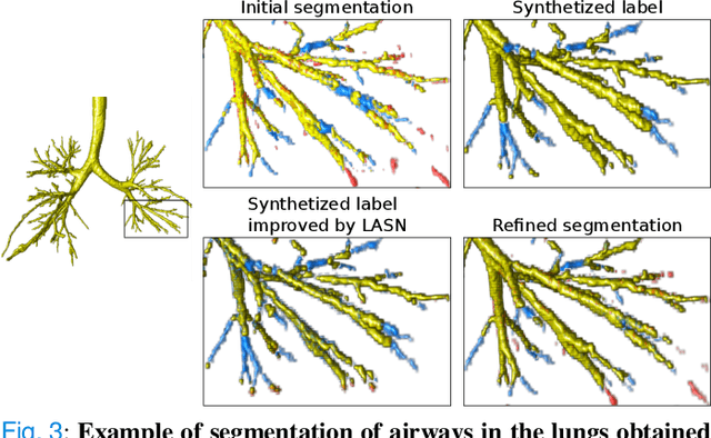 Figure 3 for Label Refinement Network from Synthetic Error Augmentation for Medical Image Segmentation