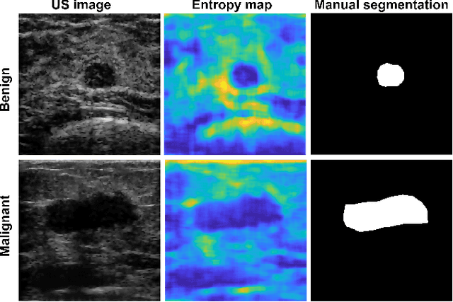 Figure 2 for Breast mass segmentation based on ultrasonic entropy maps and attention gated U-Net