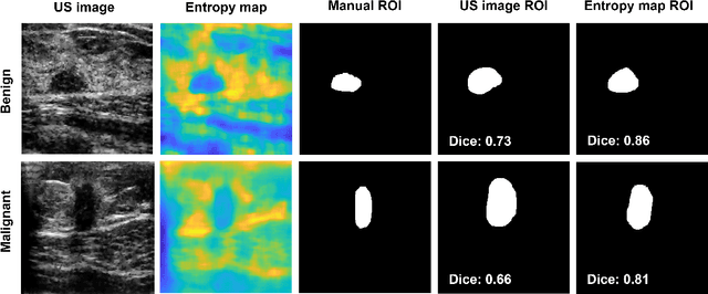 Figure 4 for Breast mass segmentation based on ultrasonic entropy maps and attention gated U-Net