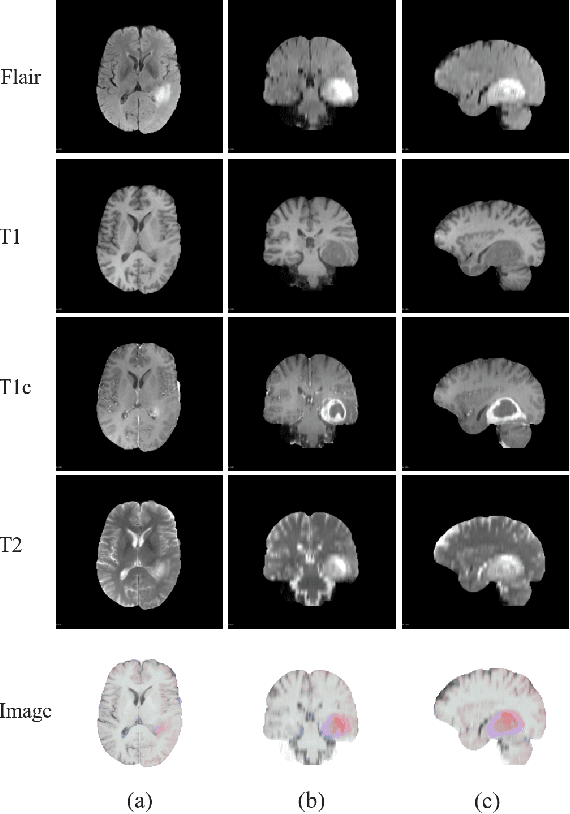 Figure 1 for A Multi-View Dynamic Fusion Framework: How to Improve the Multimodal Brain Tumor Segmentation from Multi-Views?