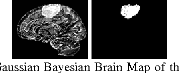 Figure 2 for Fully Automatic Brain Tumor Segmentation using a Normalized Gaussian Bayesian Classifier and 3D Fluid Vector Flow