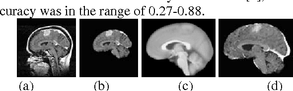 Figure 3 for Fully Automatic Brain Tumor Segmentation using a Normalized Gaussian Bayesian Classifier and 3D Fluid Vector Flow