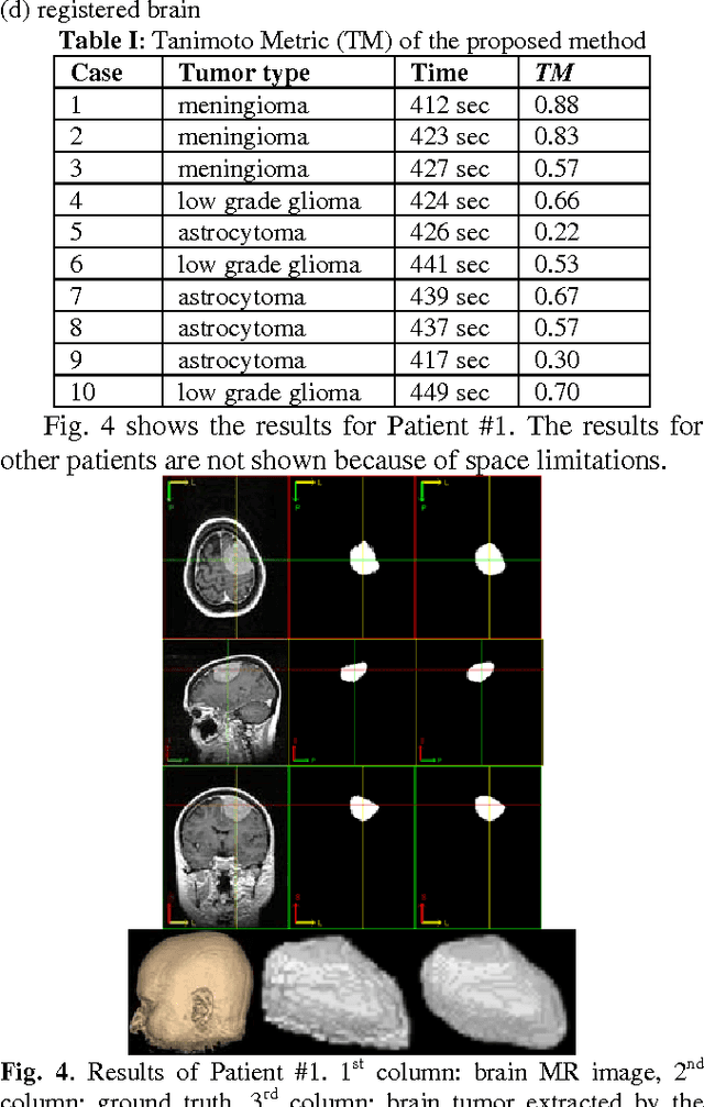 Figure 4 for Fully Automatic Brain Tumor Segmentation using a Normalized Gaussian Bayesian Classifier and 3D Fluid Vector Flow