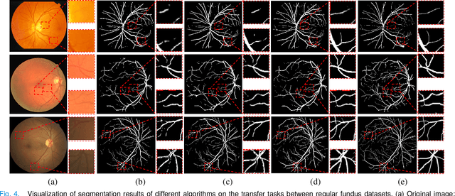 Figure 4 for Unsupervised Domain Adaptation for Retinal Vessel Segmentation with Adversarial Learning and Transfer Normalization