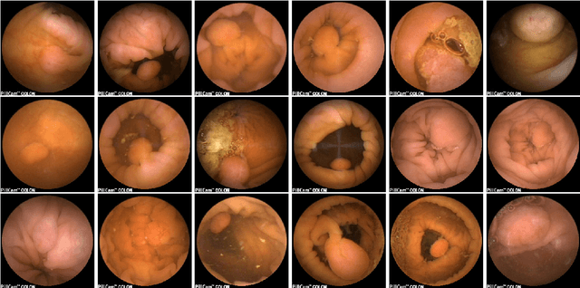 Figure 1 for Polyp Detection and Segmentation from Video Capsule Endoscopy: A Review