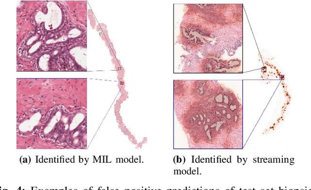 Figure 4 for Detection of prostate cancer in whole-slide images through end-to-end training with image-level labels