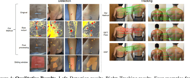 Figure 4 for Skin Cancer Detection and Tracking using Data Synthesis and Deep Learning