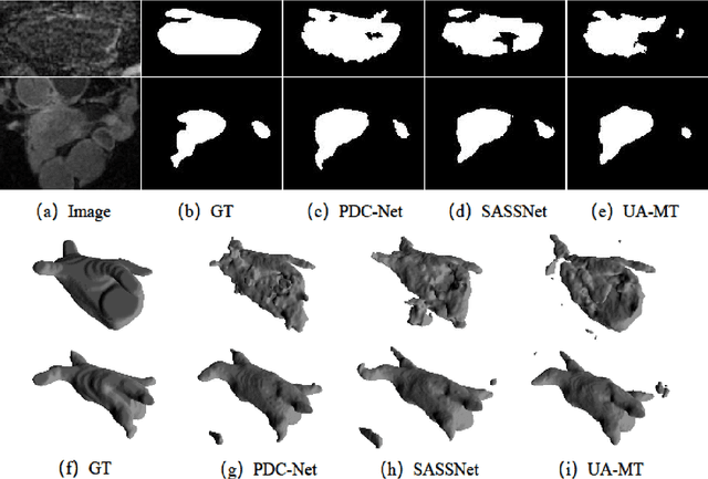 Figure 2 for Parameter Decoupling Strategy for Semi-supervised 3D Left Atrium Segmentation