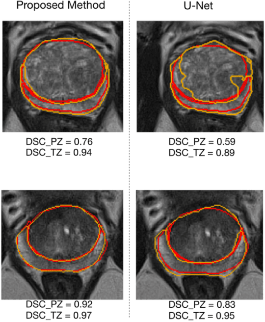 Figure 4 for Automatic Prostate Zonal Segmentation Using Fully Convolutional Network with Feature Pyramid Attention
