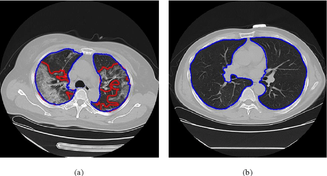 Figure 1 for Deep learning to estimate the physical proportion of infected region of lung for COVID-19 pneumonia with CT image set