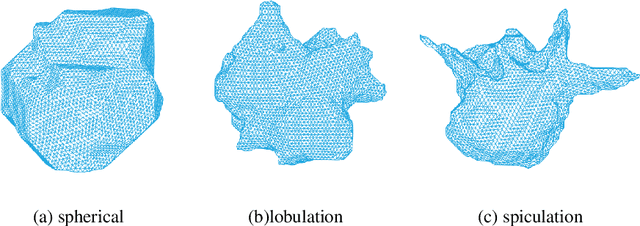 Figure 1 for Classification of lung nodules in CT images based on Wasserstein distance in differential geometry