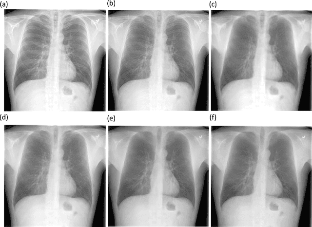 Figure 4 for Chest X-Ray Bone Suppression for Improving Classification of Tuberculosis-Consistent Findings