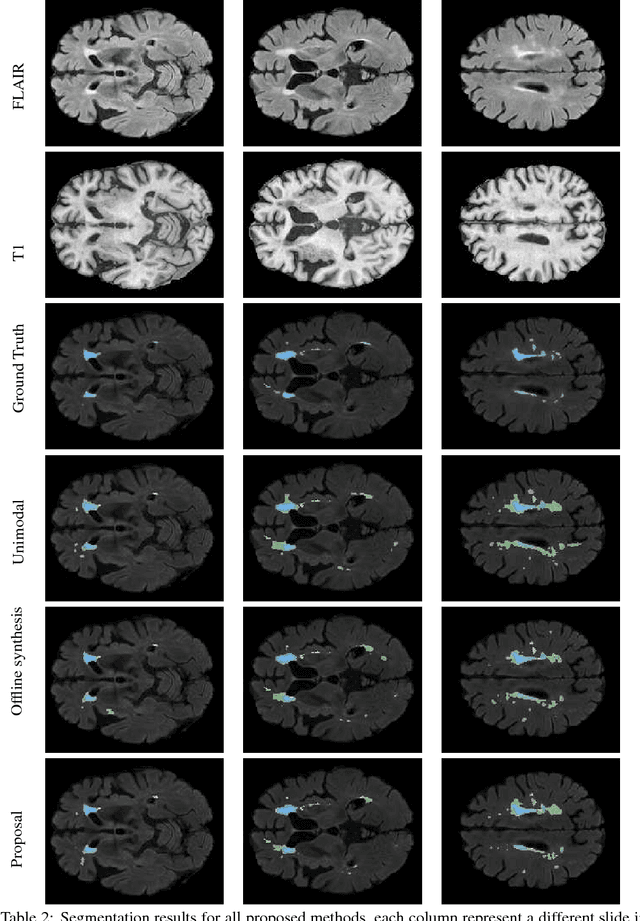 Figure 4 for Simultaneous synthesis of FLAIR and segmentation of white matter hypointensities from T1 MRIs