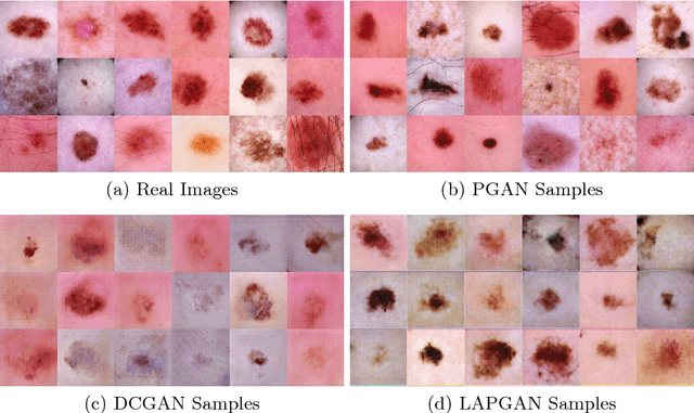 Figure 1 for Generating Highly Realistic Images of Skin Lesions with GANs