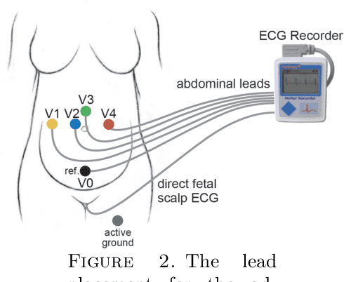 Figure 3 for Efficient fetal-maternal ECG signal separation from two channel maternal abdominal ECG via diffusion-based channel selection