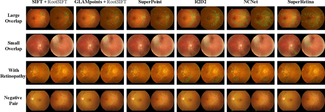 Figure 1 for Semi-Supervised Keypoint Detector and Descriptor for Retinal Image Matching