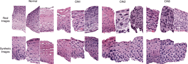 Figure 3 for Synthetic Augmentation and Feature-based Filtering for Improved Cervical Histopathology Image Classification