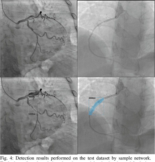 Figure 4 for A Review of Modern Approaches for Coronary Angiography Imaging Analysis