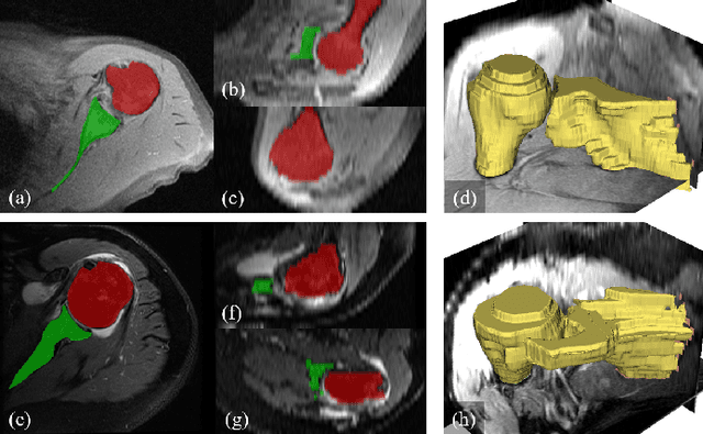 Figure 2 for Recursive 3D Segmentation of Shoulder Joint with Coarse-scanned MR Image