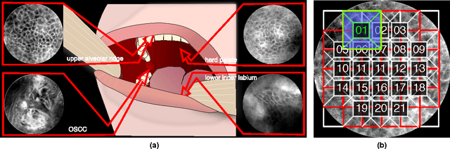 Figure 1 for Automatic Classification of Cancerous Tissue in Laserendomicroscopy Images of the Oral Cavity using Deep Learning