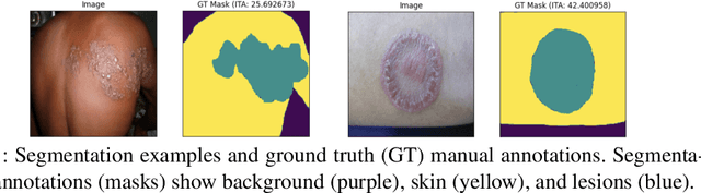 Figure 1 for EdgeMixup: Improving Fairness for Skin Disease Classification and Segmentation