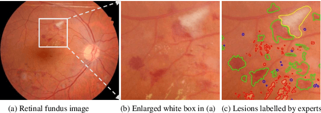 Figure 1 for M2MRF: Many-to-Many Reassembly of Features for Tiny Lesion Segmentation in Fundus Images