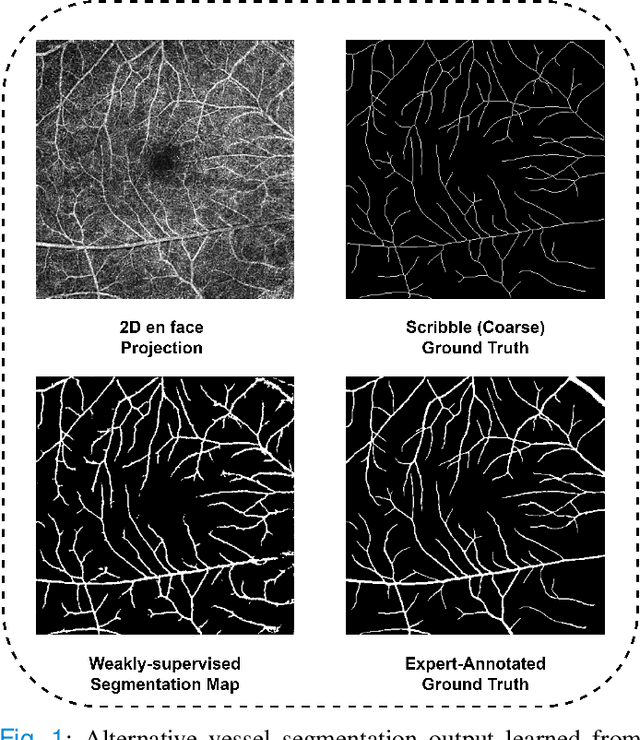 Figure 1 for OCTAve: 2D en face Optical Coherence Tomography Angiography Vessel Segmentation in Weakly-Supervised Learning with Locality Augmentation
