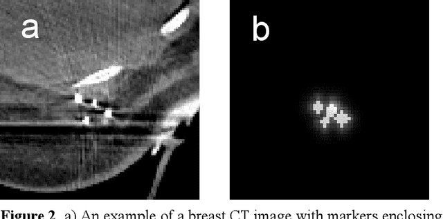 Figure 3 for Saliency-Guided Deep Learning Network for Automatic Tumor Bed Volume Delineation in Post-operative Breast Irradiation