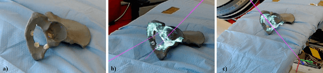 Figure 4 for Closing the Calibration Loop: An Inside-out-tracking Paradigm for Augmented Reality in Orthopedic Surgery