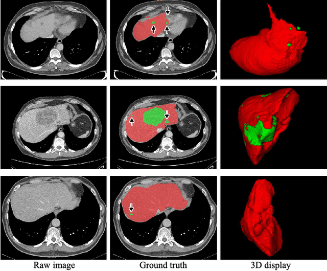 Figure 1 for H-DenseUNet: Hybrid Densely Connected UNet for Liver and Tumor Segmentation from CT Volumes
